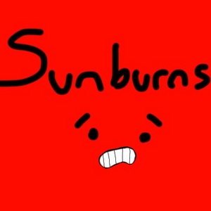 Sunburns